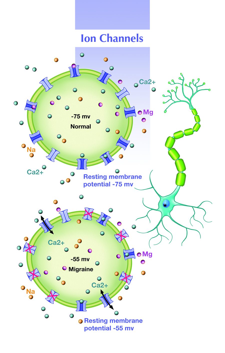 Ion channels in a nerve cell, normal compared with migraine